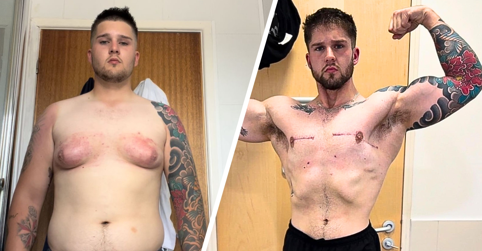 Man Bullied Over His 'Man Boobs' Says He Taped Them Under Armpits For Years To Hide Them