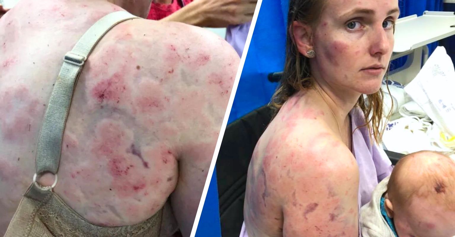 Australian Mom Uses Her Body To Protect Her Baby During A Violent Hail Storm