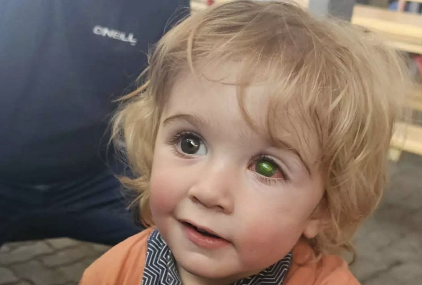 Toddler Lost Sight As Eye Began To ‘Melt Away’ After Being Kissed By Someone With Herpes