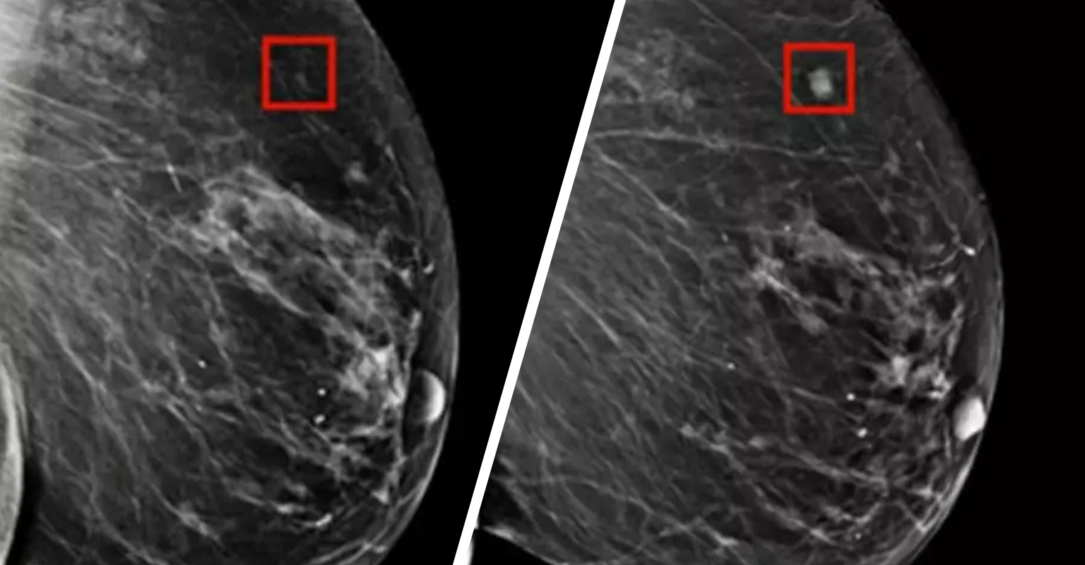 AI Saves Woman’s Life By Detecting Breast Cancer 4 Years Before It Developed
