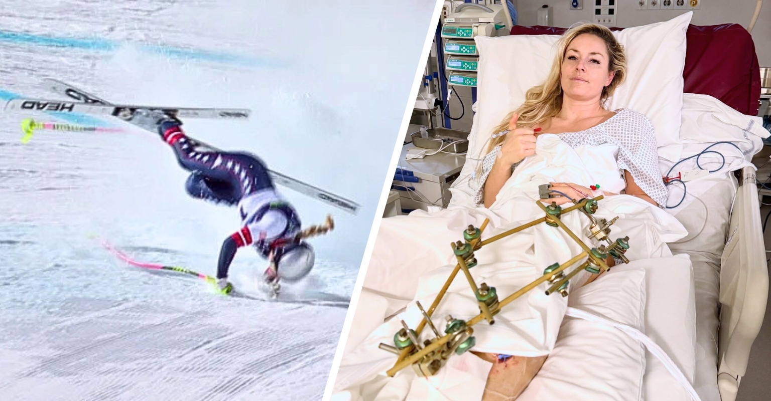 Doctor Shares Image Of ‘Lindsey Vonn Injury’ To Show The Extent Of Her Condition